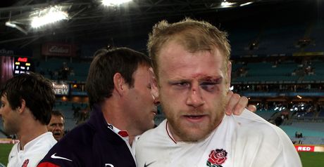 Cole: Stitches above eye