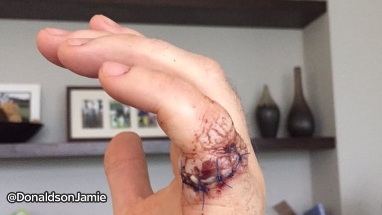 Donaldson posted a picture of his hand injury on Twitter