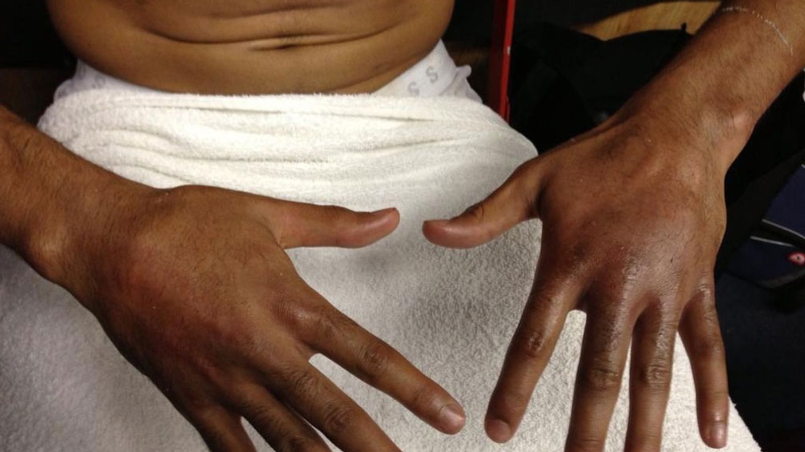 Amir Khan fractures both hands in victory over Carlos Molina Boxing