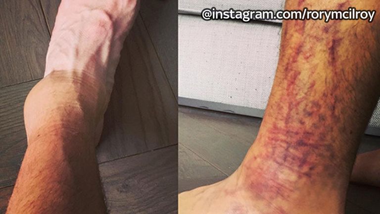 Rory McIlroy posted an image of his injury on Instagram 