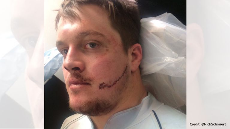 Nicholas Schonert tweeted a picture of his injury.