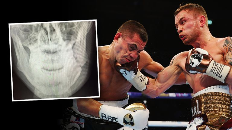 An x-ray shows the fracture Scott Quigg has sustained to his jaw.