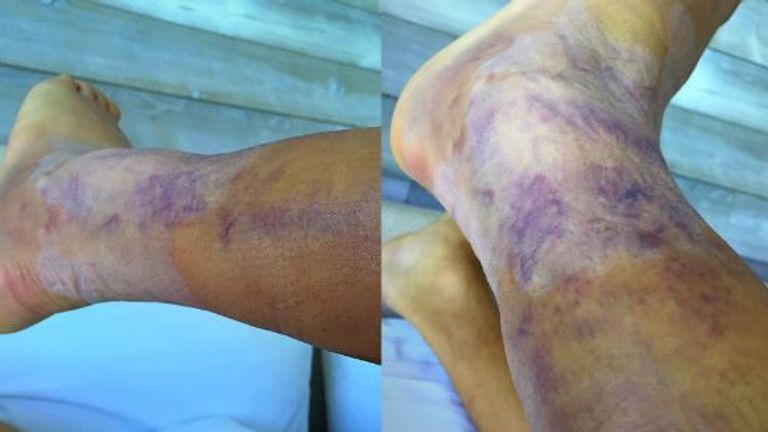 Alexis Sanchez shows off his injuries (Copyright: Twitter @Alexis_Sanchez)
