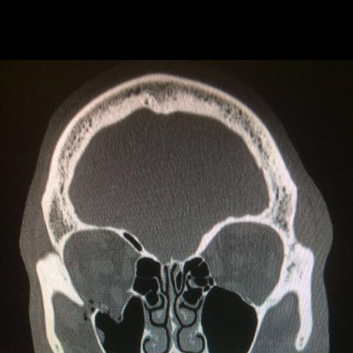 Brook to undergo surgery