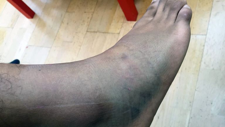 Gamal Yafai's injured ankle