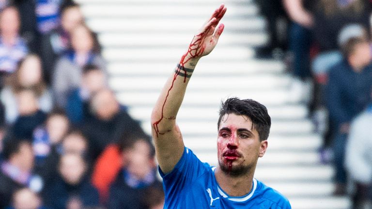 Rangers' Fabio Cardoso and his bloodied nose at Hampden Park