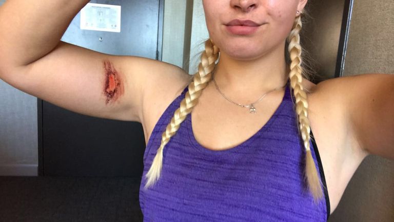 Kinghorn shows off her war wounds in Chicago