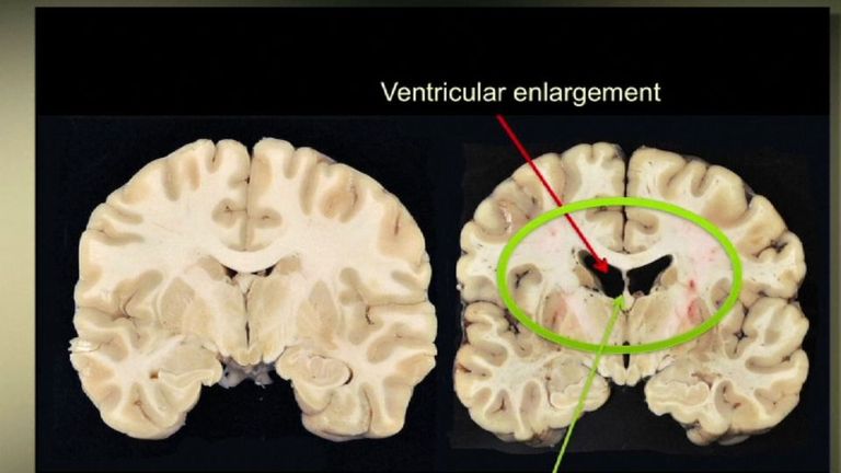 A normal 27 year-old's brain alongside Aaron Hernandez's brain. Pic: Boston University CTE Center
