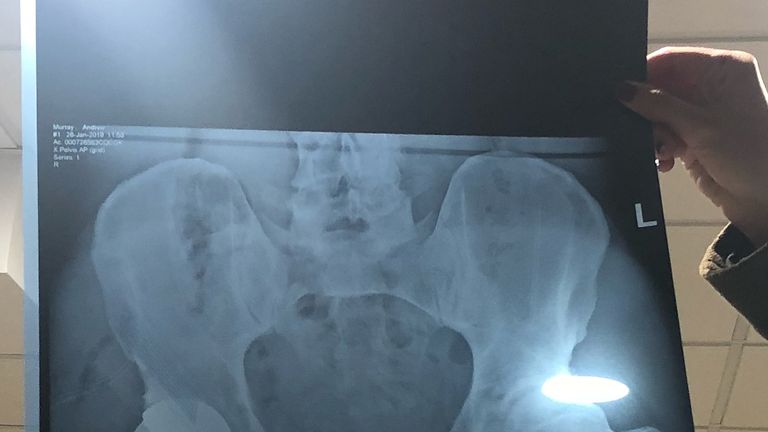 The x-ray show's Andy Murray's new metal hip (Credit @andymurray Instagram) 