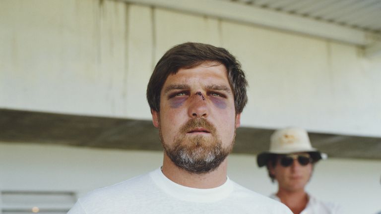 Mike Gatting with a broken nose during England tour of West Indies in 1986