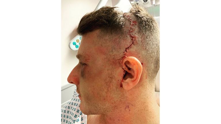 Sam Ward posted images of his injury to social media (@samuel_ward13)