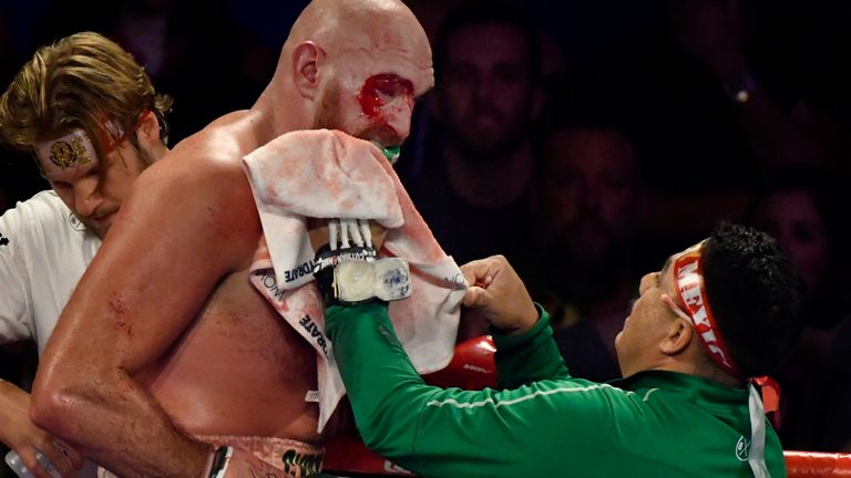 Jorge Capetillo tends to the bleeding above Fury's eye