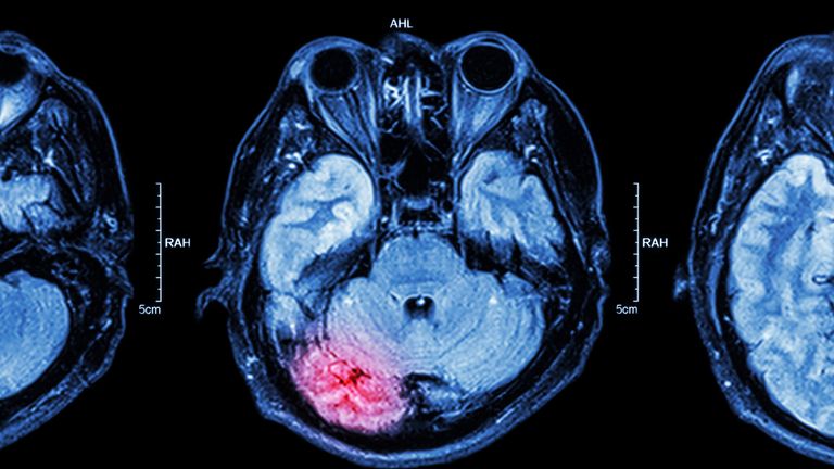Close up of MRI brain : Lower part of brain ( eyes , temporal lobe of cerebrum , cerebellum , brain stem )