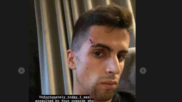 Joao Cancelo revealed injuries to his face after claiming he was robbed and assaulted (Instagram story: @jpcancelo)