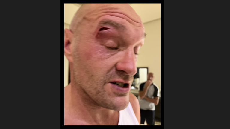 Tyson Fury's cut from sparring (Credit: Queesnberry)