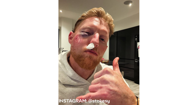 Ben Stokes suffered significant injury after being hit by a cricket ball.